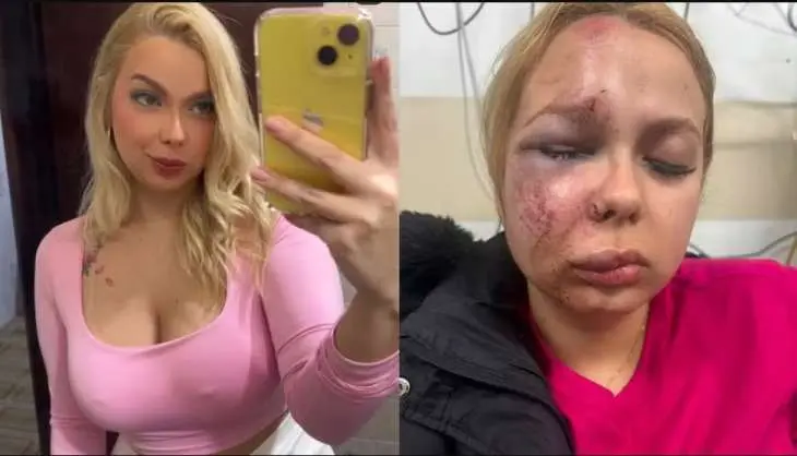 Mulher espancada no Metrô de SP tem rosto e joelho fraturados e denuncia tentativa de feminicídio Mulher espancada no Metrô de SP tem rosto e joelho fraturados e denuncia tentativa de feminicídio